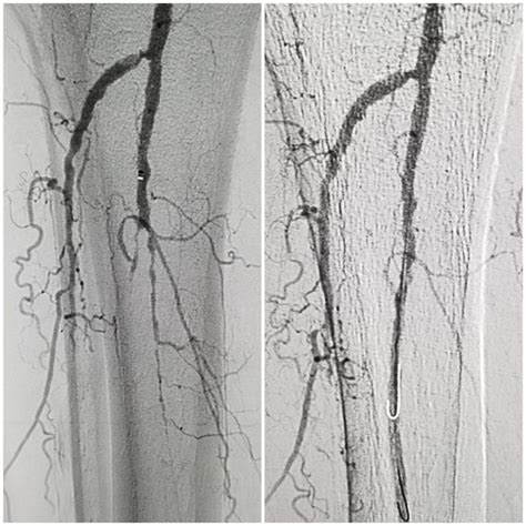 Endovascular Services