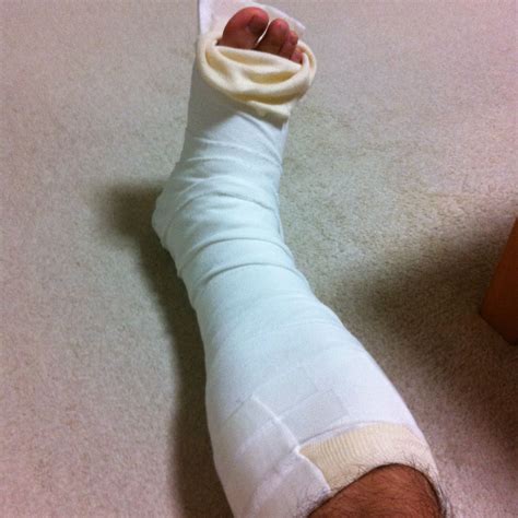 injured leg… Injured, Socks, Legs, Quick, Fashion, Moda, Fashion Styles ...