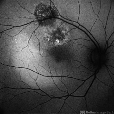 CHOROIDAL HEMANGIOMA - Retina Image Bank