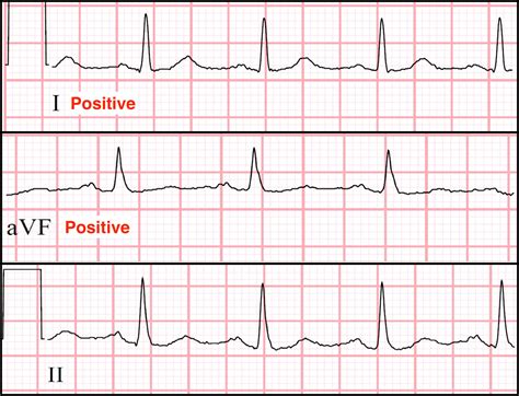 Axis Deviation Ekg Chart