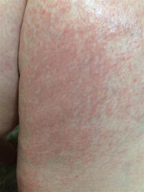 Painful rash on inner thighs when cold/hot : r/skin