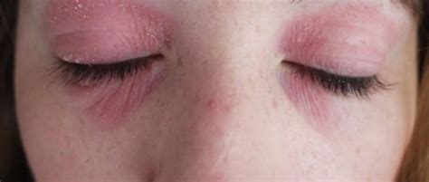 This Miracle Cream Got Rid Of My Eye Eczema [with Photos]