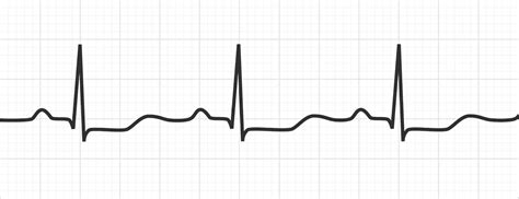 Hypokalemia Ecg