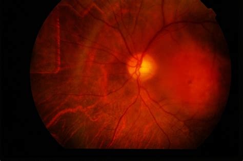 Choroidal Hemangioma - Retina Image Bank