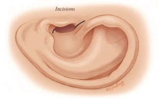 Postauricular Meatoplasty – Oto Surgery Atlas