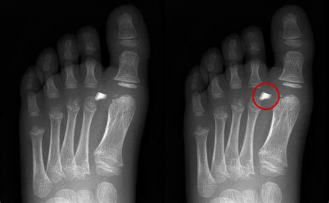 Trauma X-ray - Lower limb gallery 2 - Foot - Foreign bodies