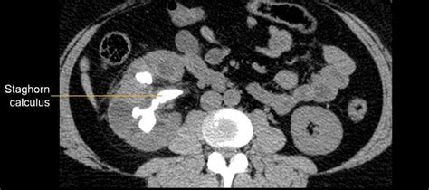 Abdominal CT: renal infections • LITFL • Radiology Library