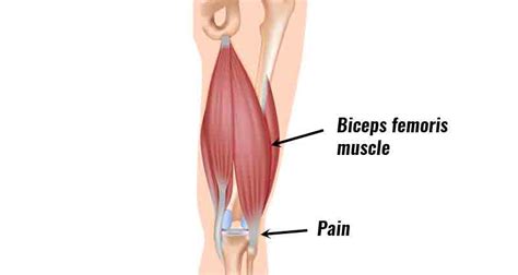 Biceps femoris muscle pull: Cause, Diagnosis, Treatment, Exercise