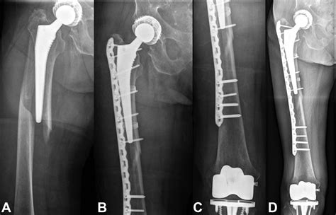 Periprosthetic Femur Fractures Orthopaedicprinciples | The Best Porn ...