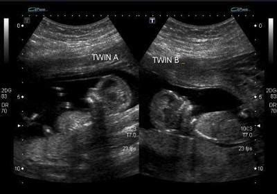 Fraternal Twins - 13 Weeks Ultrasound