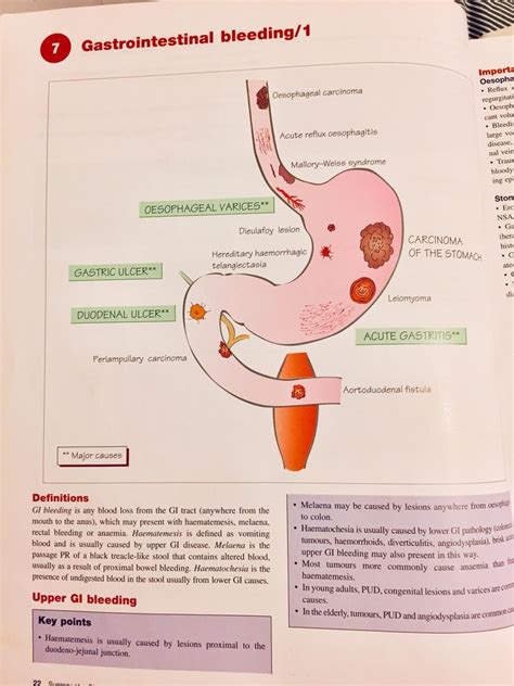 Upper GI Bleeding (Surgery) Diagram | Quizlet