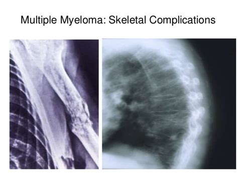 Plasma Cell Disorders