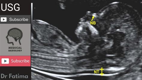 Fetal Nuchal translucency & Nuchal fold ultrasound by Dr.Fatima - YouTube