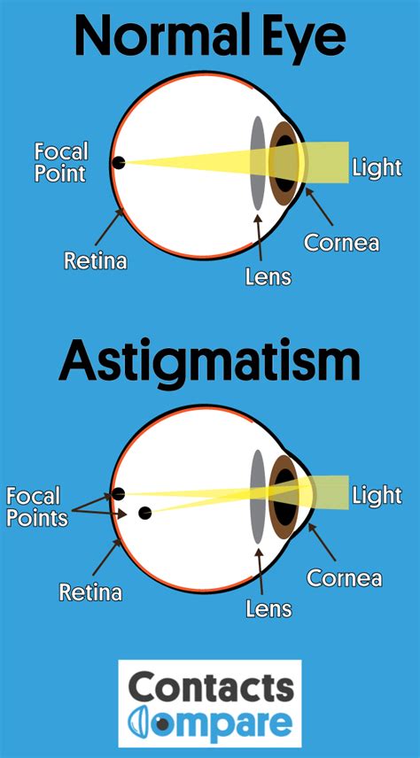 Astigmatism: Causes, Symptoms, Treatments | Contacts Compare