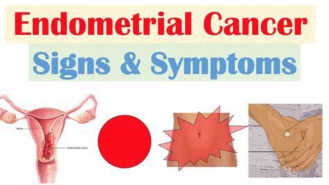 Endometrial Cancer Signs & Symptoms (& Why They Occur) - YouTube