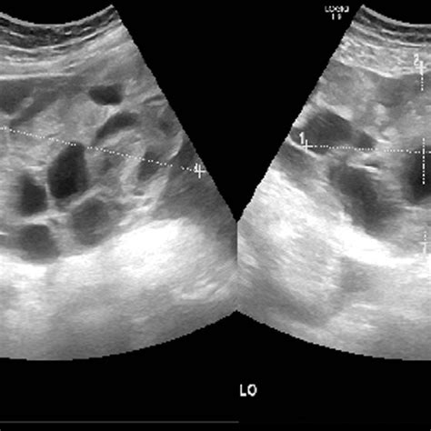 The fundus of the uterus after its closure in 3 layers. No evidence of ...