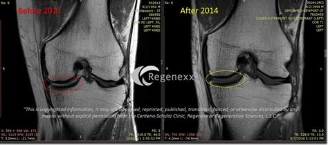 Can Stem Cells Help Knee Arthritis? - Regenexx®