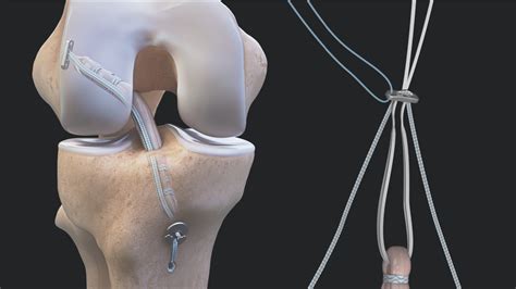 Arthrex - GraftLink® Technique Using FiberTape® Suture for the ...