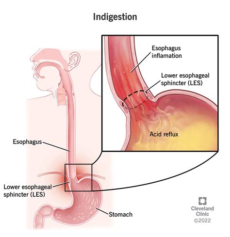 Understanding The Symptoms And Treatment Of Indigestion - Ask The Nurse ...