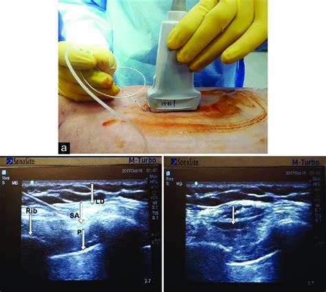 Serratus anterior plane block procedure. (a) The needle and probe ...