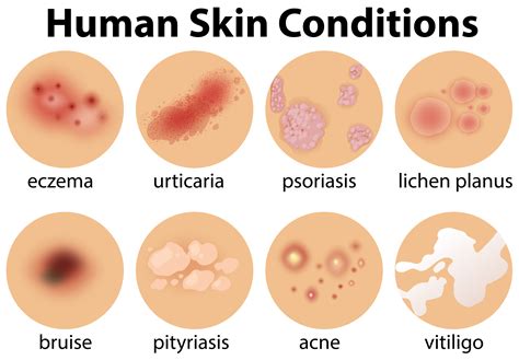 Vector Diseases List - Photos