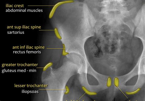 Hip X Ray Anatomy