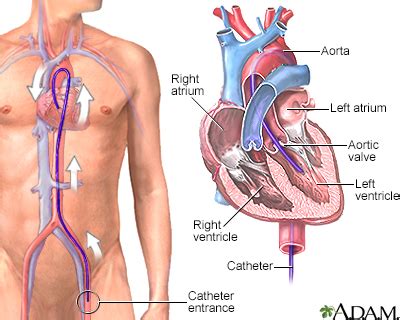 Left heart catheterization Information | Mount Sinai - New York