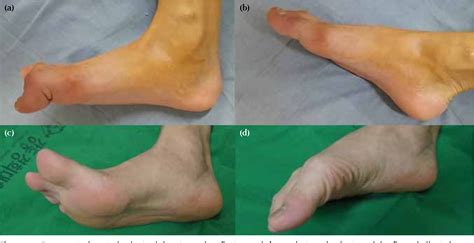 Figure 1 from Z-Plasty of the Flexor Hallucis Longus Tendon at Tarsal ...