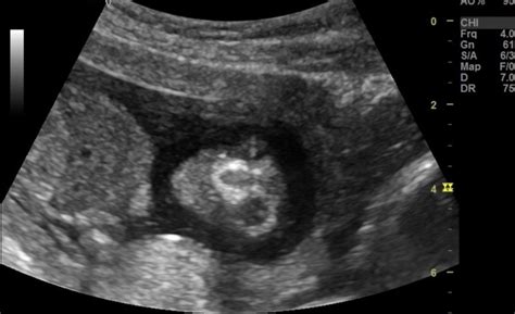 Anencephaly Ultrasound