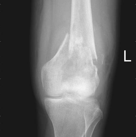 Osteosarcoma Radiology