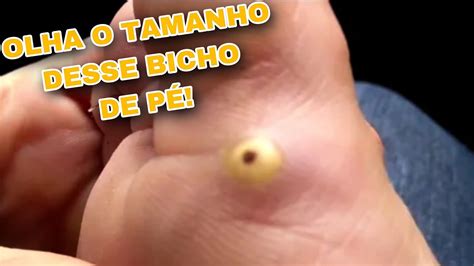 TIRANDO BICHO DE PÉ 😷!!! - YouTube