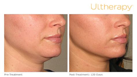 ULTHERAPY - An easy way to combat those ‘sagging jowls’