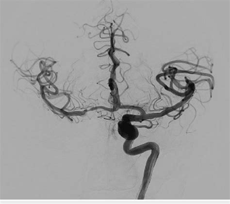 Anterior posterior cerebral angiogram demonstrating filling of right ...