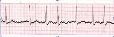 Atrial Fibrillation - EKG Lesson #312