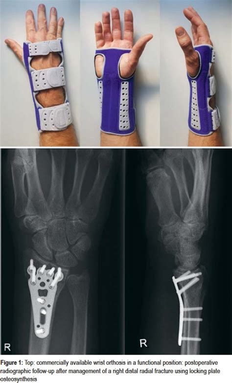 Early Mobilization Versus Splinting After Surgical Management of Distal ...