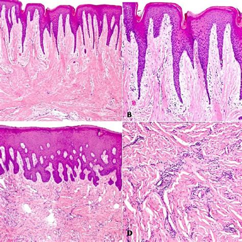 Photomicrography of the gingiva showing the histopathological features ...