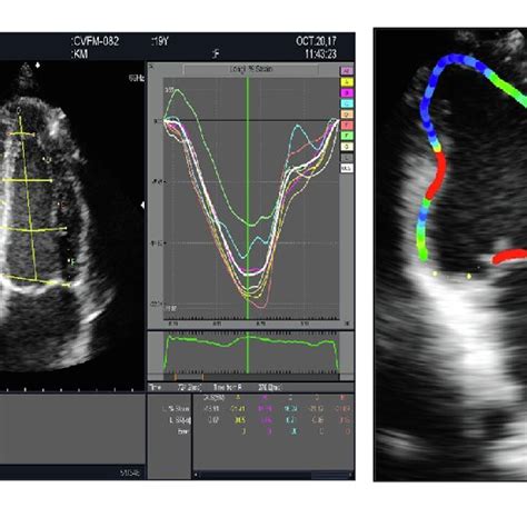 Representation of Vector Flow Mapping software utilized for ...