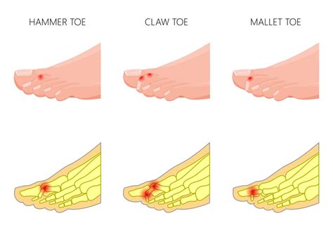 #post_titleUnderstanding Hammer Toe Causes and How To Treat It