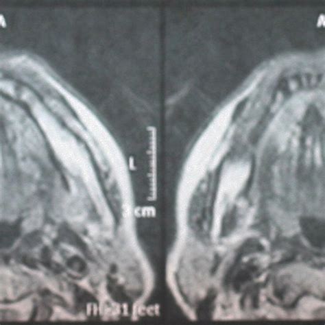 Diffuse, firm, palpable swelling across the sublingual folds ...