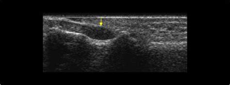 Musculoskeletal Joints and Tendons | 6.4 Fingers : Case 6.4.5 Tumors ...