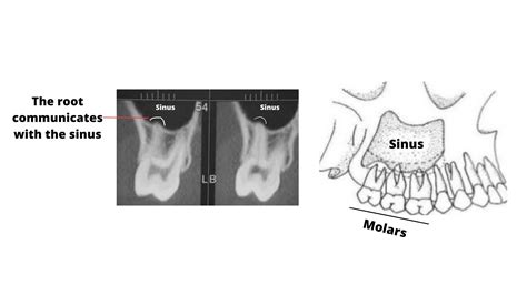 Sinus Tooth Pain: Understanding the Two-Way Relationship