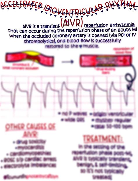 Accelerated Idioventricular Rhythm AIVR - Etsy