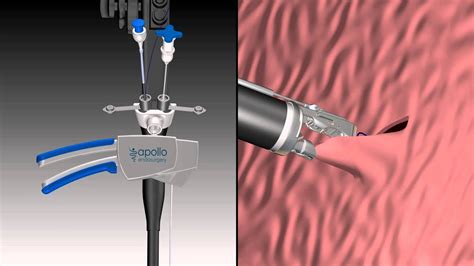 OverStitch™ Animation - Endoscopic and External Views - YouTube