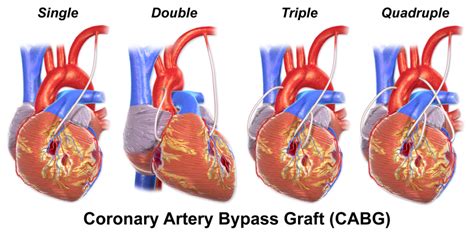 What is Difference Between CABG and PCI | Compare the Difference ...