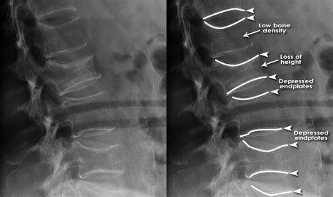 Types Of Lumbar Spine X Ray - Design Talk