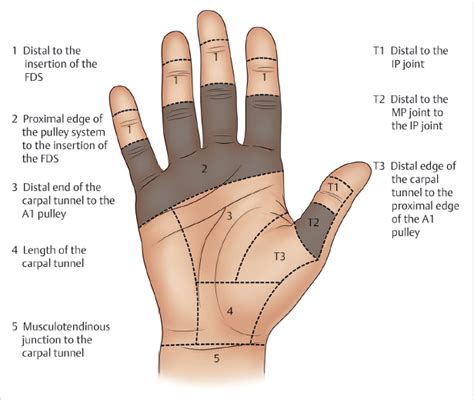 4 Flexor Tendon Repair (Zone 2) | Plastic Surgery Key