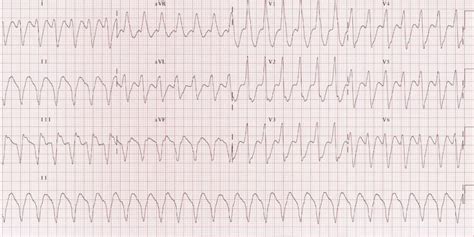 Ventricular Tachycardia