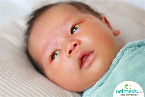 Newborn Jaundice: Causes, Symptoms And Treatment | Netmeds