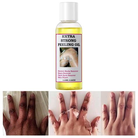 Yellow Peeling Oil for Dark Skin - Strong Extra Strength Exfoliating ...