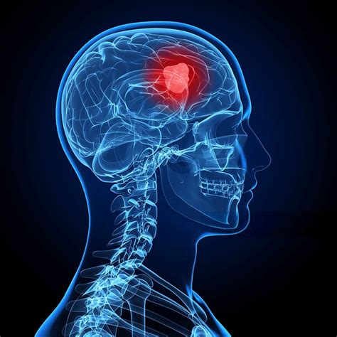 Brain tumor symptoms and causes - HealthZigZag